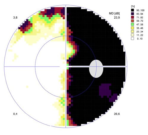 DEFECTOS DEL CAMPO VISUAL