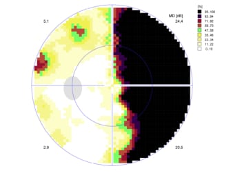 Defectos del Campo Visual