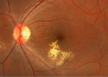 Neuropatias Ópticas